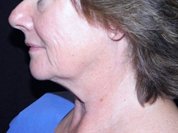 Face and Neck Lift with Smartlipo Neck and Jowls