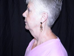 Face and Neck Lift with Smartlipo Neck and Jowls