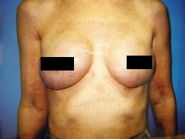 Breast Reconstruction with Tissue Expansion followed by Replacement with Permanent Silicone Gel Implants.