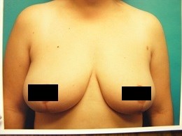 Breast Reduction (inferior pedicle technique).