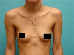 Breast Augmentation with 325cc saline implants.