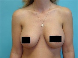 Breast Augmentation with 360cc silicone gel implants.