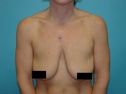 Breast Augmentation with Breast Lift using 330cc silicone gel implants.
