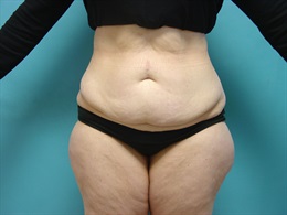 Smartlipo Abdomen, Outer and Inner Thighs.