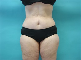 Smartlipo Abdomen, Outer and Inner Thighs.