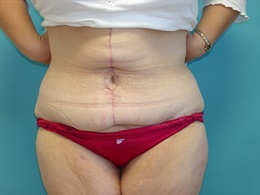 Modified Abdominoplasty with Central Wedge Excision after Gastric Bypass.